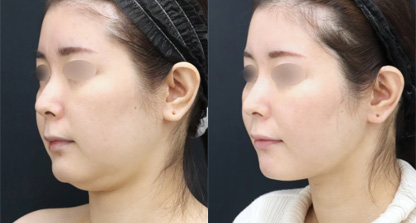 アキーセル脂肪吸引 症例写真