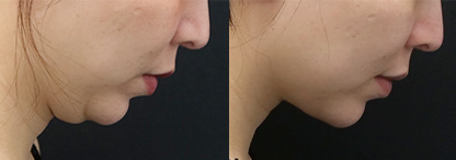 テスリフト 症例写真