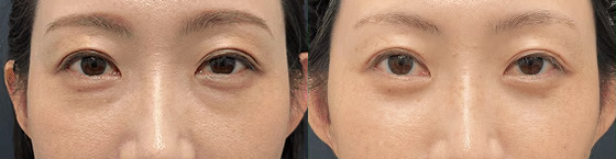 クマ取り 症例写真2 Before After