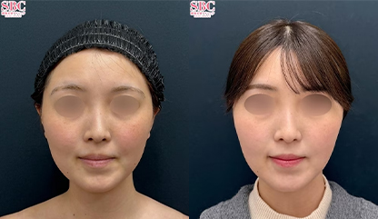 脂肪吸引注射 症例写真 No.359140