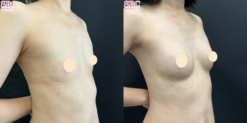 週末豊胸 -ピュアグラフト- 症例写真 Before After