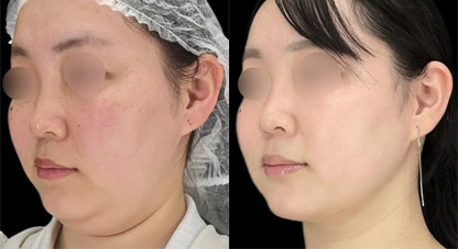 ベイザー脂肪吸引 症例写真