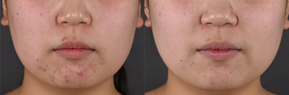 ピコスポットシミ取り放題 症例写真