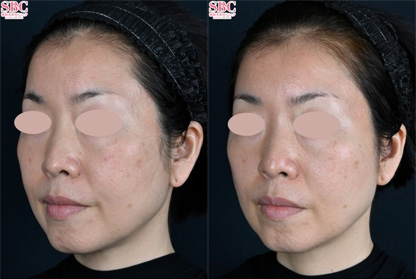 DENSITY（デンシティ） 症例写真