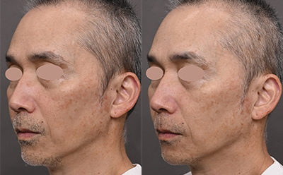 フォトジェネシス 症例写真