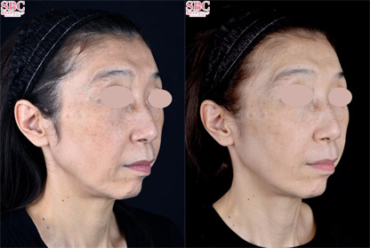 プロファイロ 症例写真