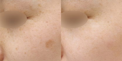 シミ取りレーザー 症例写真 Before After