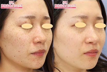 ピコトーニング 症例写真