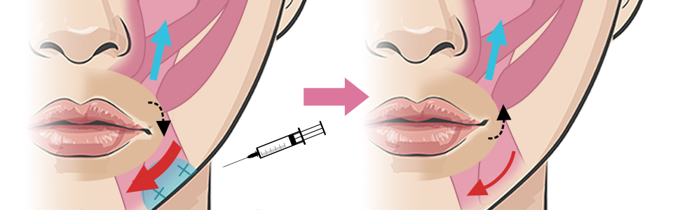 口角ボトックスの治療方法