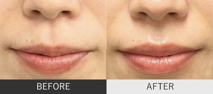 人中短縮ボトックスの症例写真（正面）