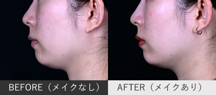 人中短縮ボトックスの症例写真（横顔）