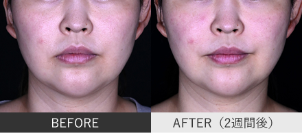 口角ボトックスの症例写真①