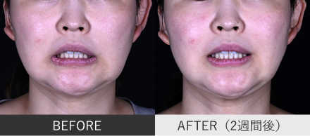 口角ボトックスの症例写真②