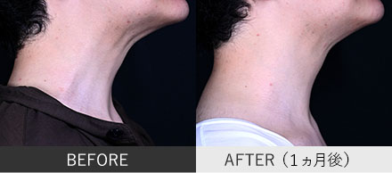 頸部ボトックスの症例写真①