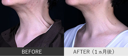 頸部ボトックスの症例写真②