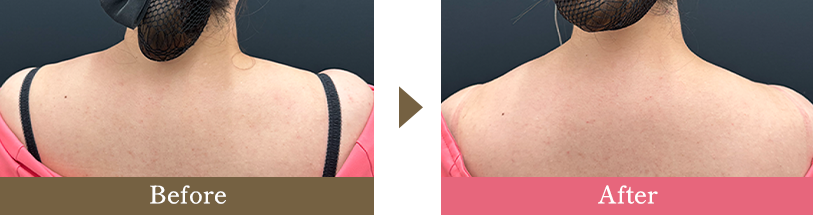 肩ボトックスの症例写真 Before After