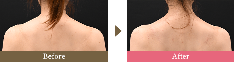 肩ボトックスの症例写真 Before After