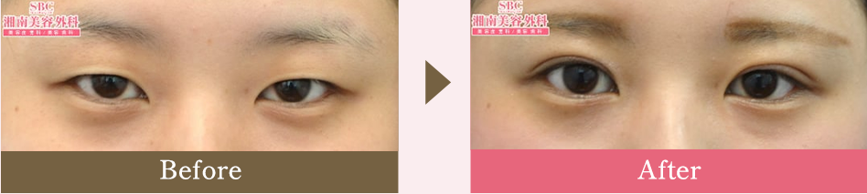 自然癒着セット（まぶたの脂肪取り）