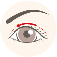 alt="腫れづらいスクエア二重術"