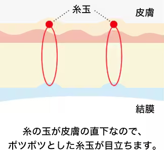 通常の埋没法 糸の玉が皮膚の直下なので、ポツポツとした糸玉が目立ちます。