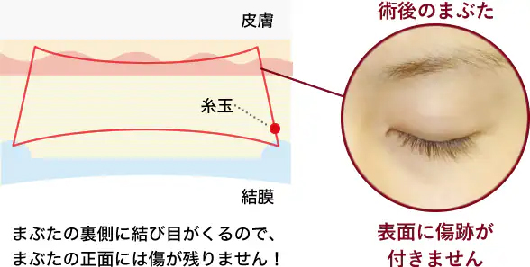 クイックコスメティークNeo まぶたの裏側に結び目がくるので、まぶたの正面には傷が残りません！