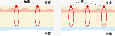 従来の埋没法