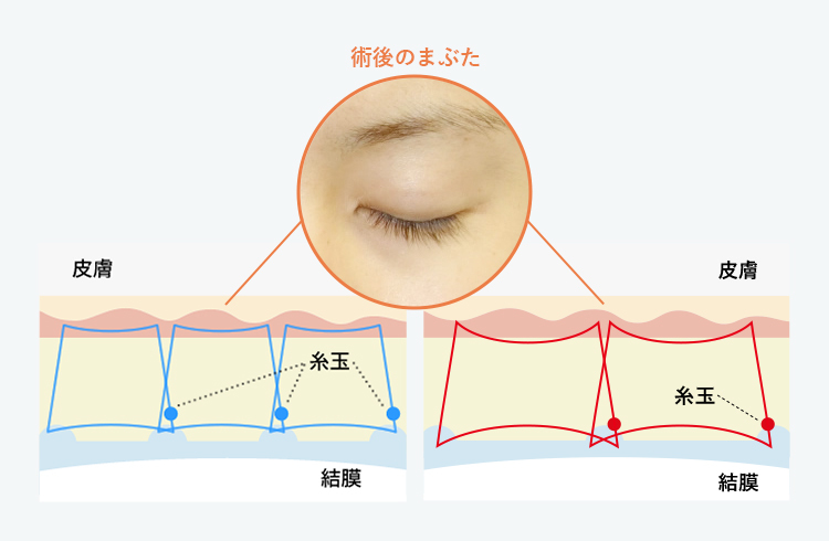 術後のまぶた