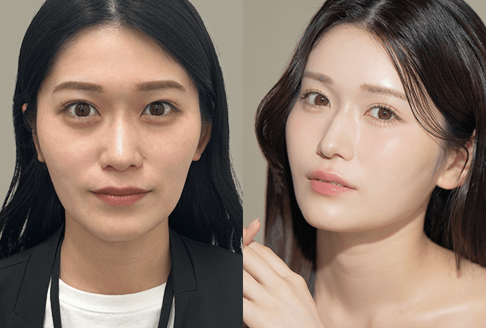 Before After 症例1