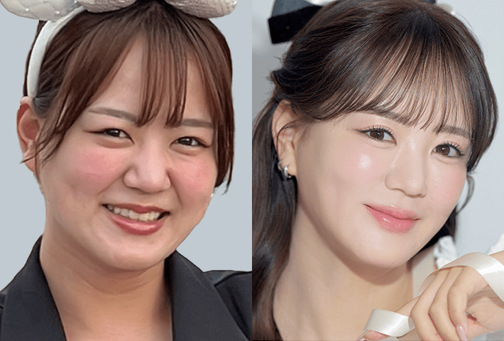 Before After 症例2