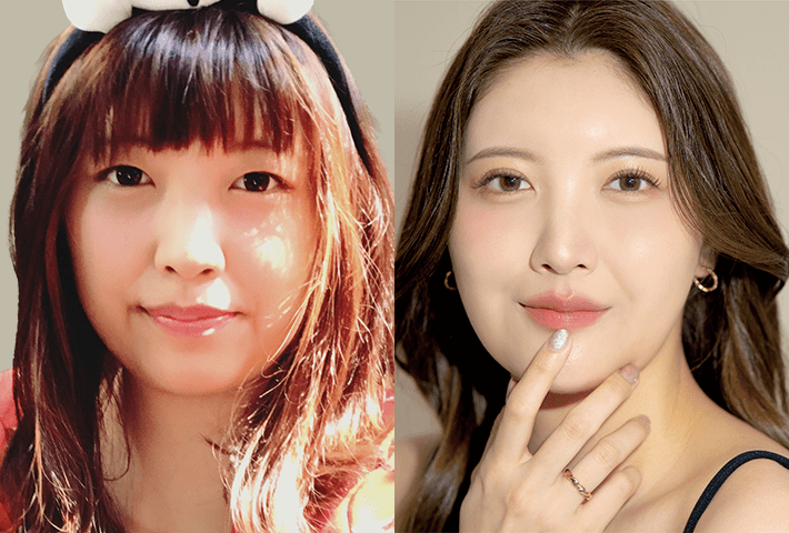 Before After 症例5