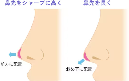 鼻先に耳の軟骨を移植