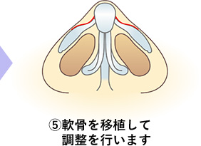 鼻尖形成術の手順5