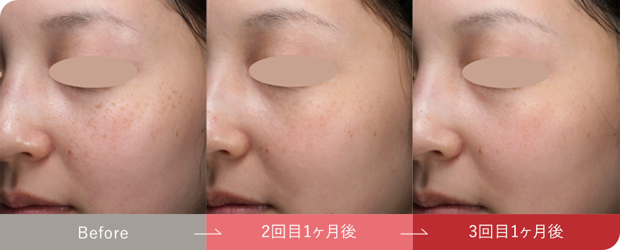 症例写真1