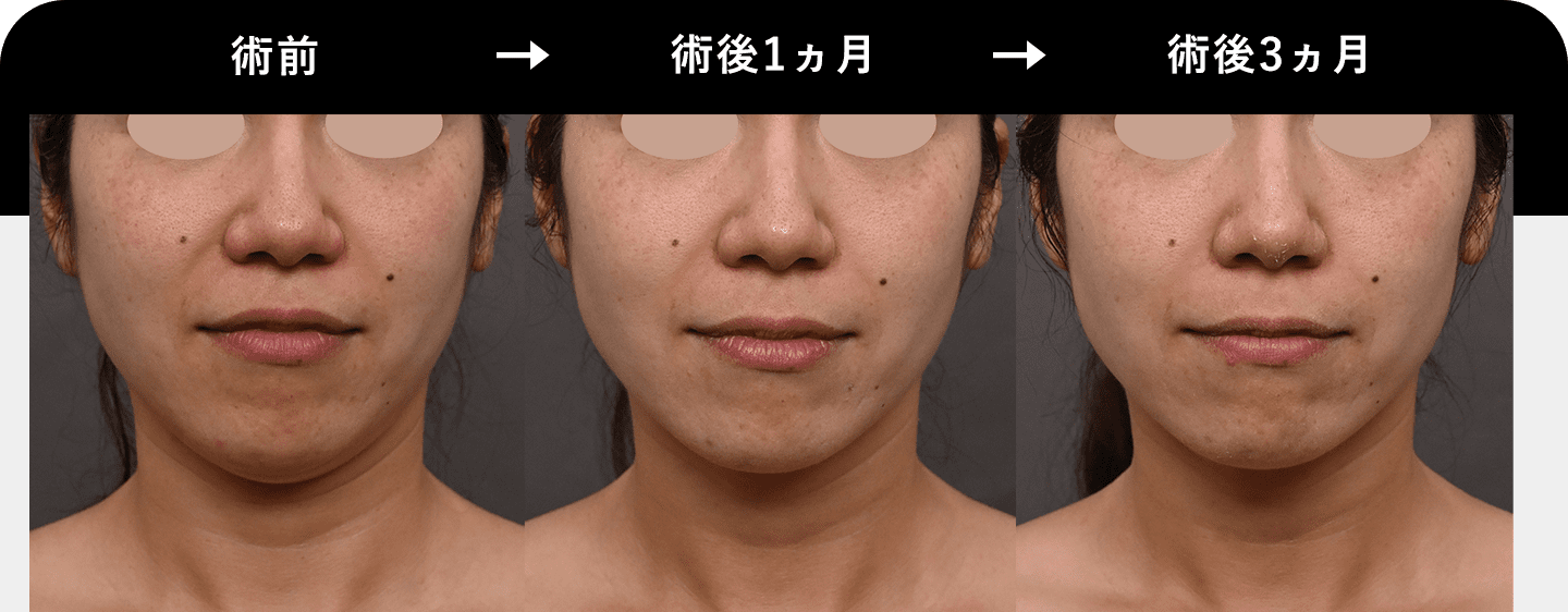 Before After