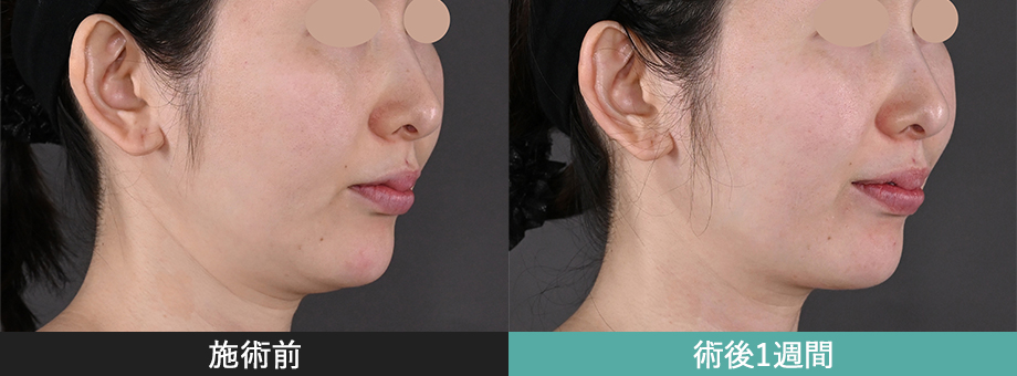 モフィウス8 症例写真 顔