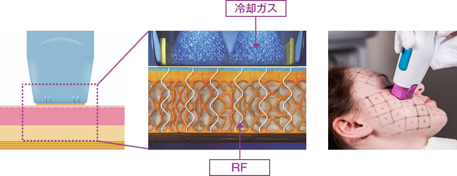サーマクールとは