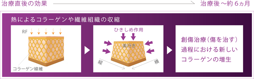 創傷治癒過程でおこる長期的なコラーゲンのリモデリング