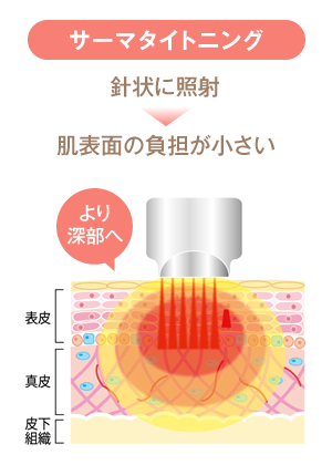 サーマタイトニング