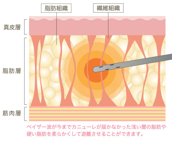 皮下脂肪の90％を除去する高い効果 画像02