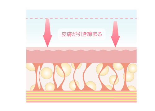 皮膚をタイトニング(引き締め) 画像