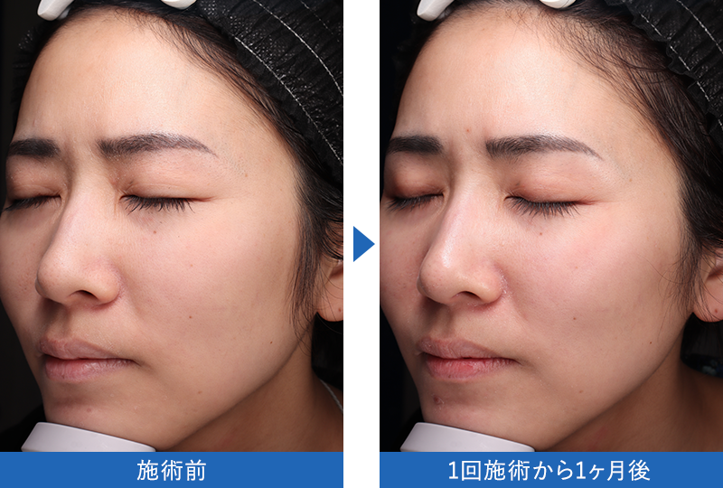 女優水光注射 症例写真 1回施術1ヶ月後