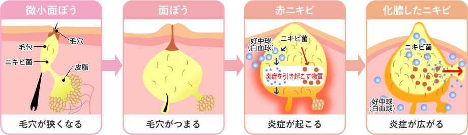 ニキビができる原因