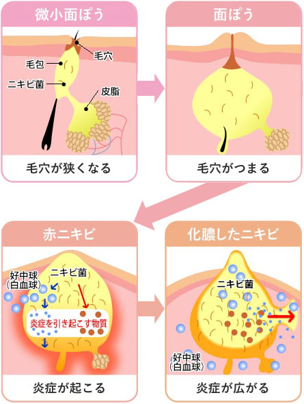 ニキビができる原因