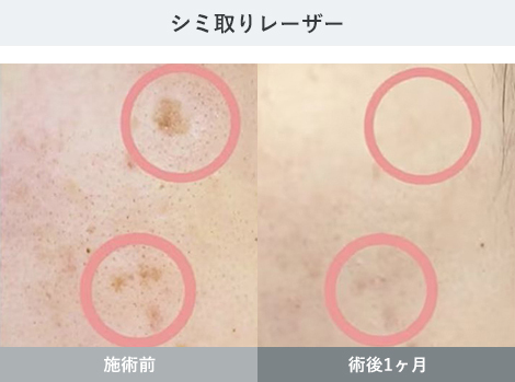 シミ・くすみ 症例写真2