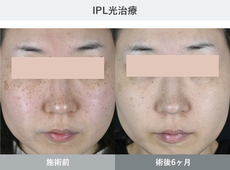 IPL光治療 症例写真2