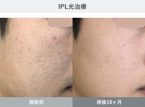 IPL光治療 症例写真3