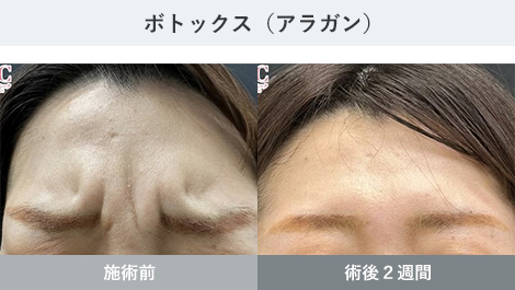 しわ 症例写真1