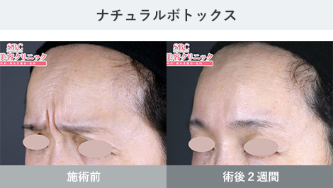 しわ 症例写真2