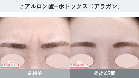 しわ 症例写真3