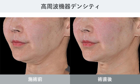 デンシティ 症例写真1